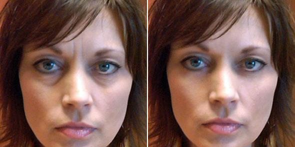 Tratamentul Cearcanelor