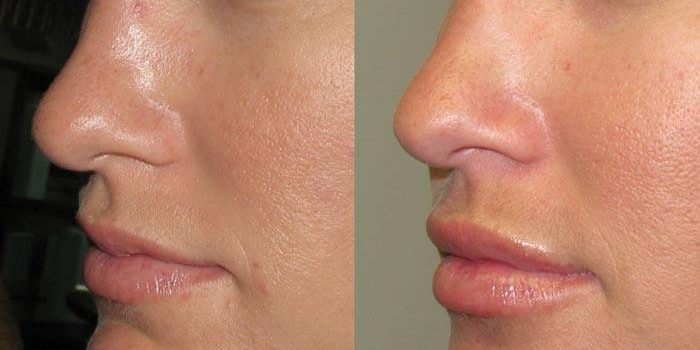 Chirurgia estetica a buzelor