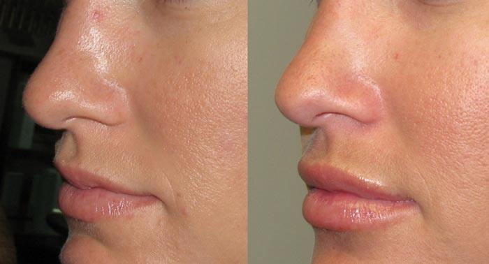 Chirurgia estetica a buzelor