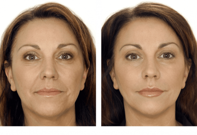 Intrebari frecvente legate de acidul hialuronic Intrebari frecvente legate de acidul hialuronic