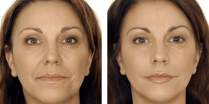 Intrebari frecvente legate de acidul hialuronic