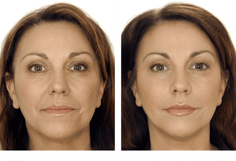 Intrebari frecvente legate de acidul hialuronic