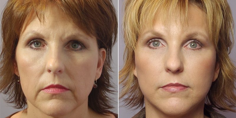 Toxina botulinica [Botox] si depresia