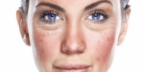 LAXITATEA CUTANATA LAXITATEA CUTANATA