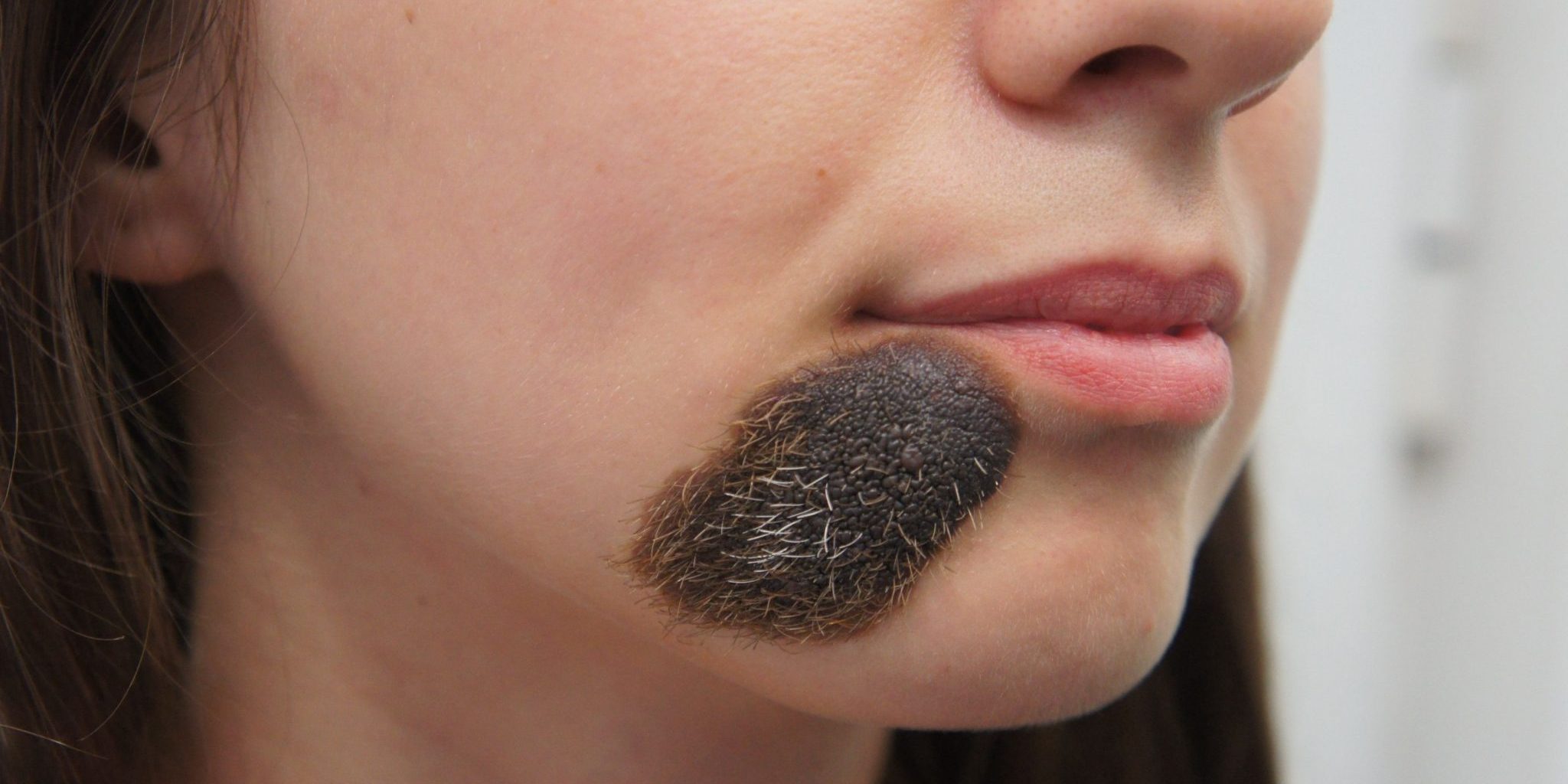 NEVUL CONGENITAL PAROS