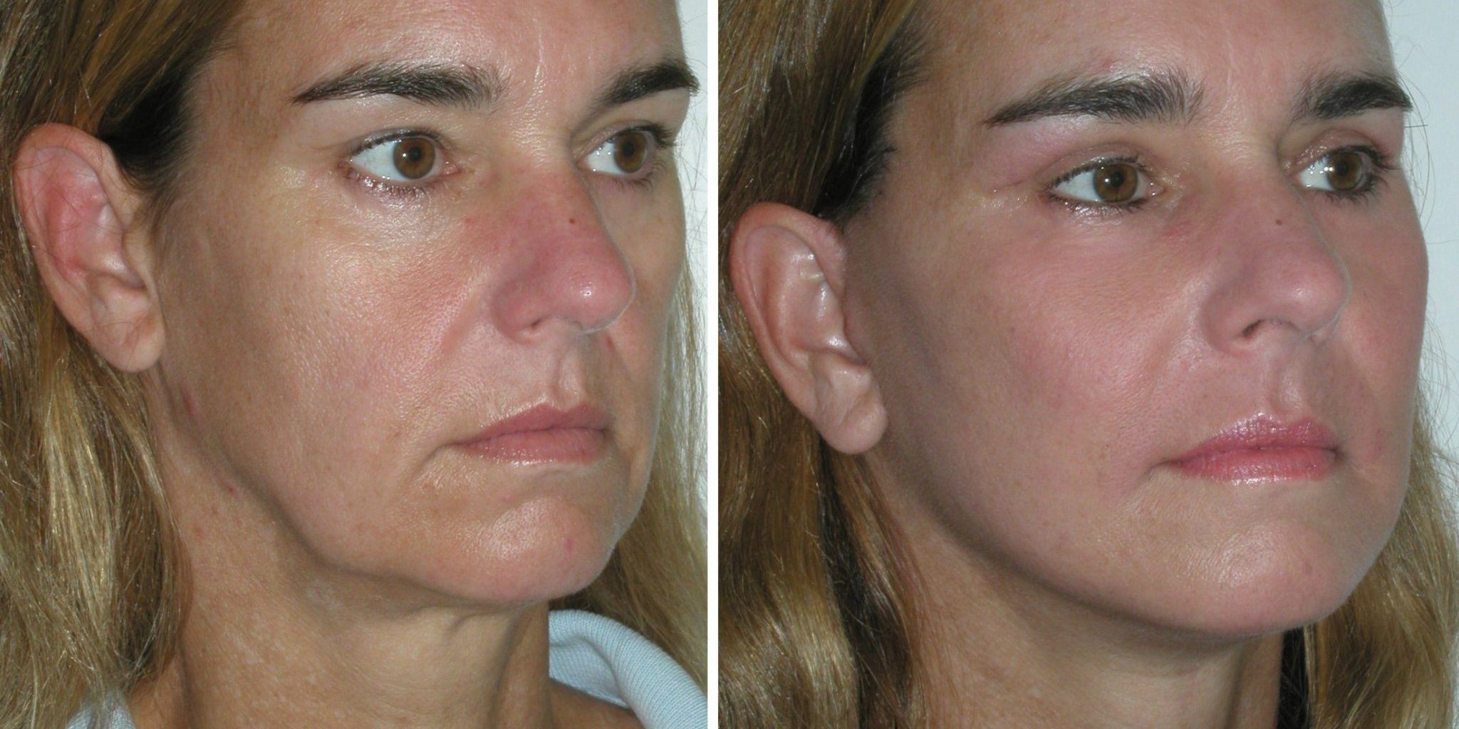 TRATAMENTE DE SEZON IN CHIRURGIA ESTETICA TRATAMENTE DE SEZON IN CHIRURGIA ESTETICA