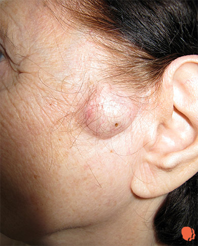 CHISTUL EPIDERMOID CHISTUL EPIDERMOID