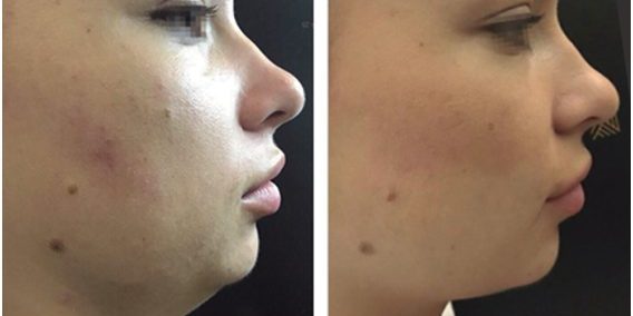 Tratamentul Barbiei Duble prin RRS CELLUTRIX