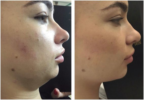 Tratamentul Barbiei Duble prin RRS CELLUTRIX