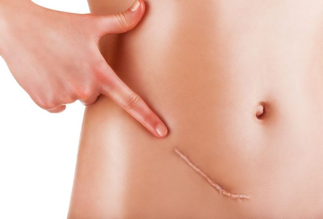 Profilaxia cicatricilor prin stratamed