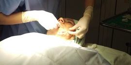 combinarea terapiei prp