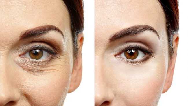 Blefaroplastia reconstructiva chirurgie estetica